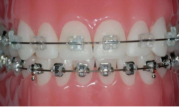 3 Things to Consider Before Getting Clear Metal Braces